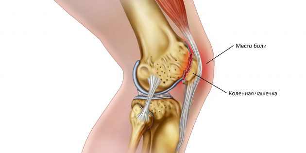 Почему болят колени: пателлофеморальный болевой синдром