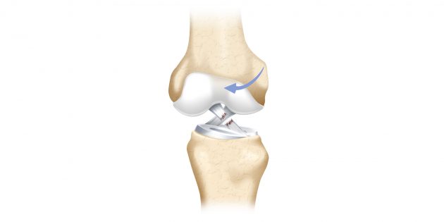 Почему болят колени: разрыв связки