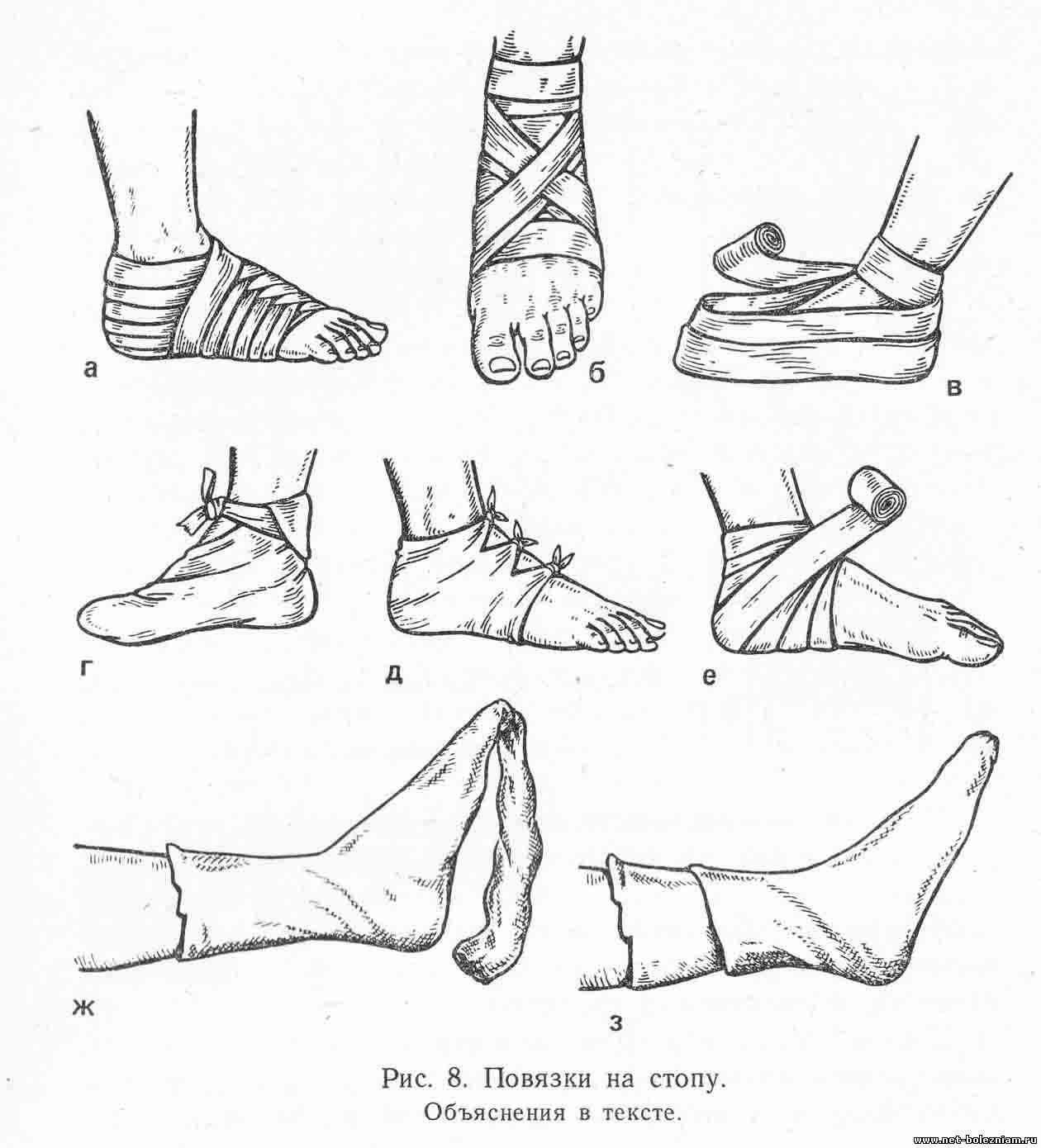 Бинтование. Схема бинтования голеностопа эластичным бинтом. Бинтование при растяжении голеностопа. Техника наложения эластичного бинта на голеностоп. Растяжение связок стопы бинтование.
