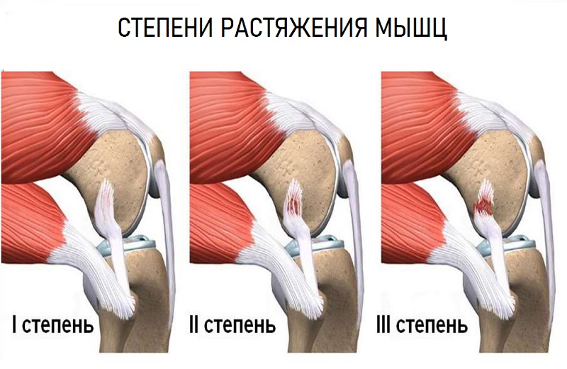 Растяжение мышц коленки