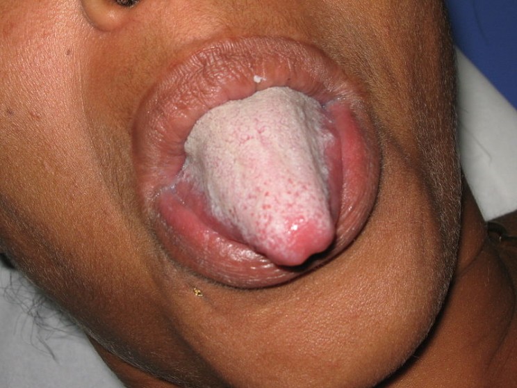 Why Does Your Tongue Turn White? Why Does Your Tongue Turn White?