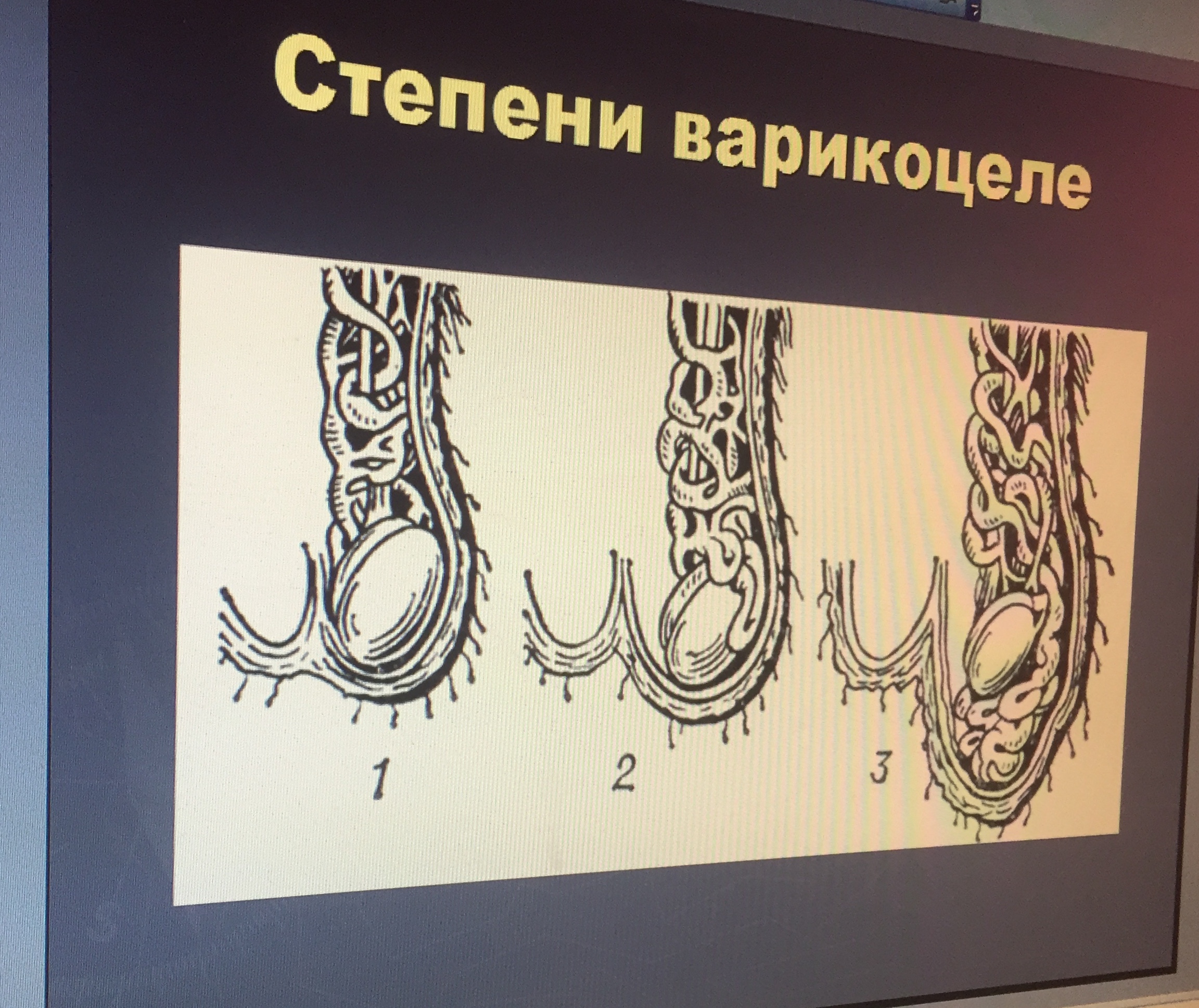 Варикоцеле отзывы мужчин