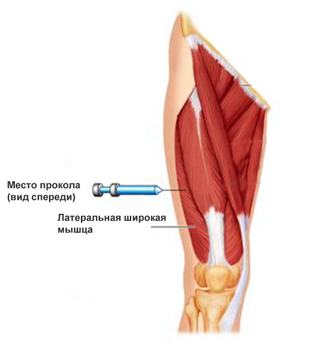 Латеральная широкая мышца бедра