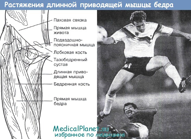 Растяжение мышц бедра. Разрыв приводящей мышцы. Надрыв приводящей мышцы бедра.