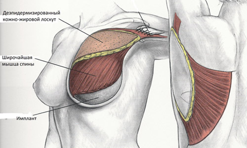 Имплант под грудную мышцу
