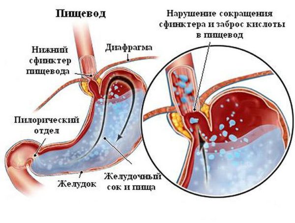 Рефлюкс-эзофагит представляет собой воспаление слизистой оболочки пищевода
