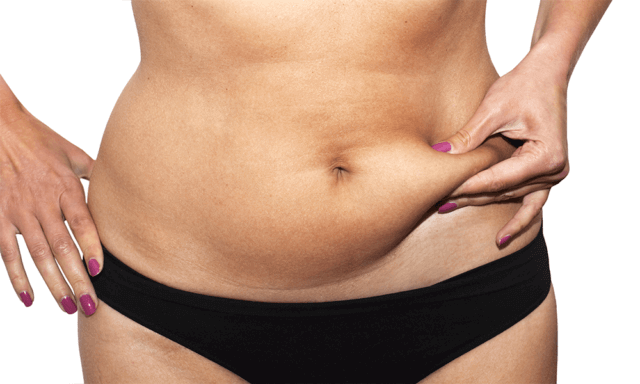 fat-freeze-vs-liposuction