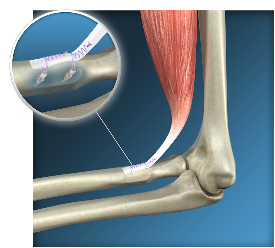 Апоневроз локтевого сустава. Разрыв сухожилия двуглавой мышцы. Разрыв сухожилия двуглавой мышцы операция. Тенодез сухожилия бицепса плечевого сустава.