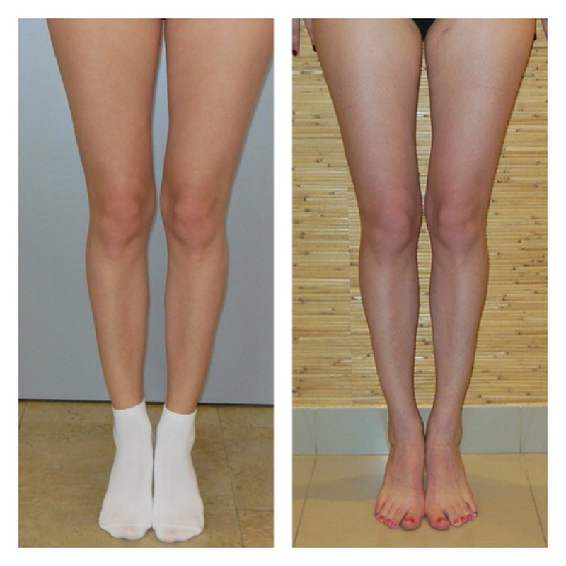 Ортопедическая операция ног. Круропластика голени асимметрия голени. Аппарат Илизарова исправление кривизны ног.