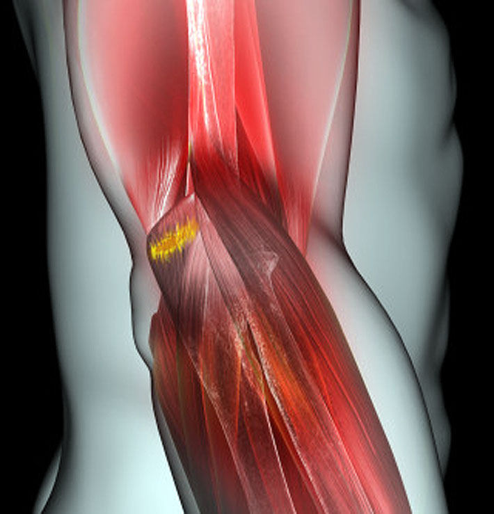 Травмы мышц и сухожилий
